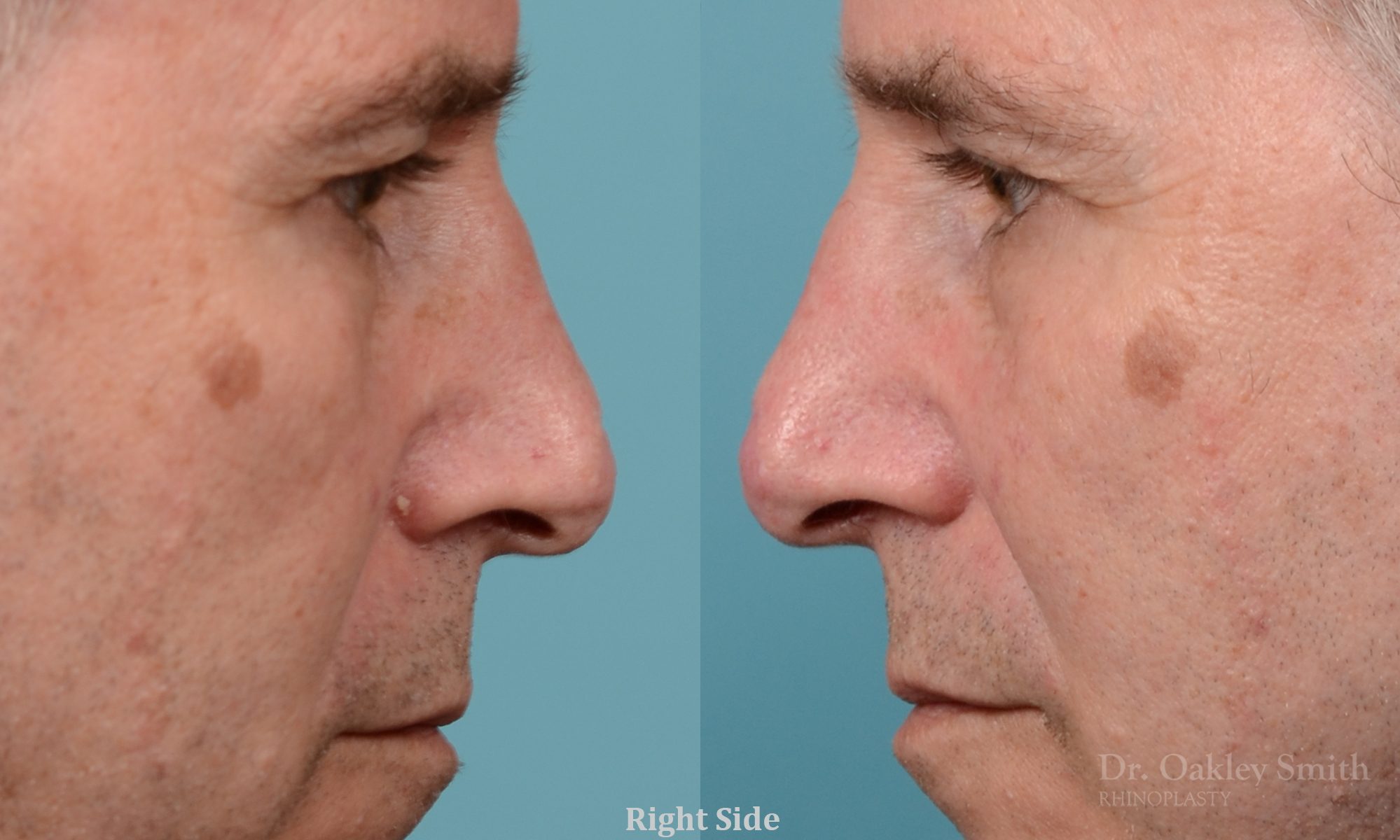 scar removal from previous surgery