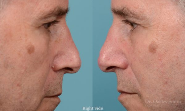 scar removal from previous surgery