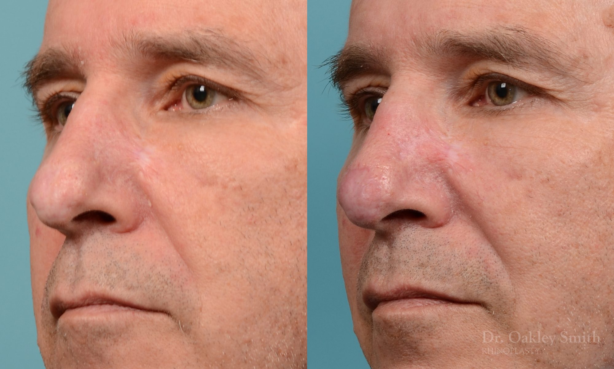 scar removal from previous surgery