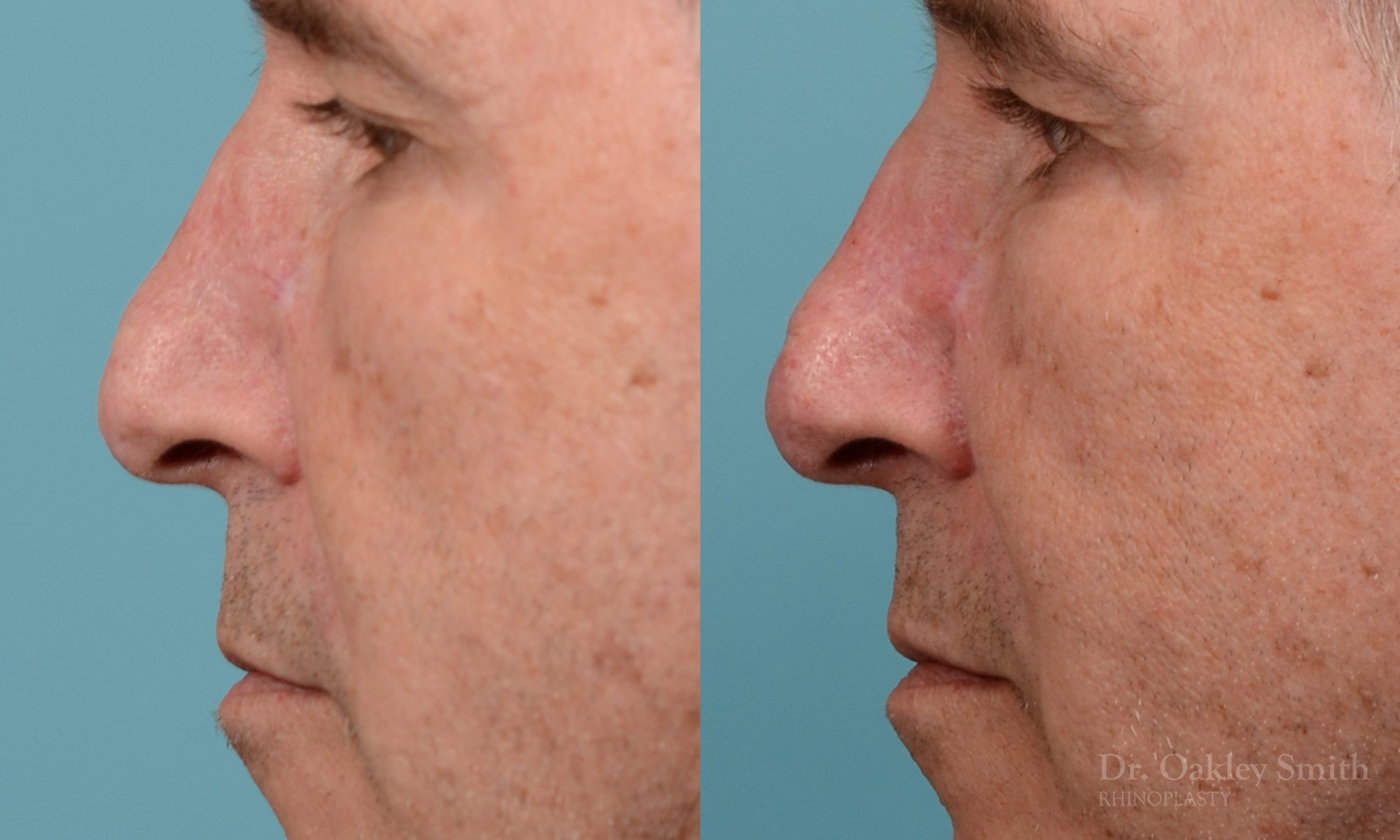 scar removal from previous surgery