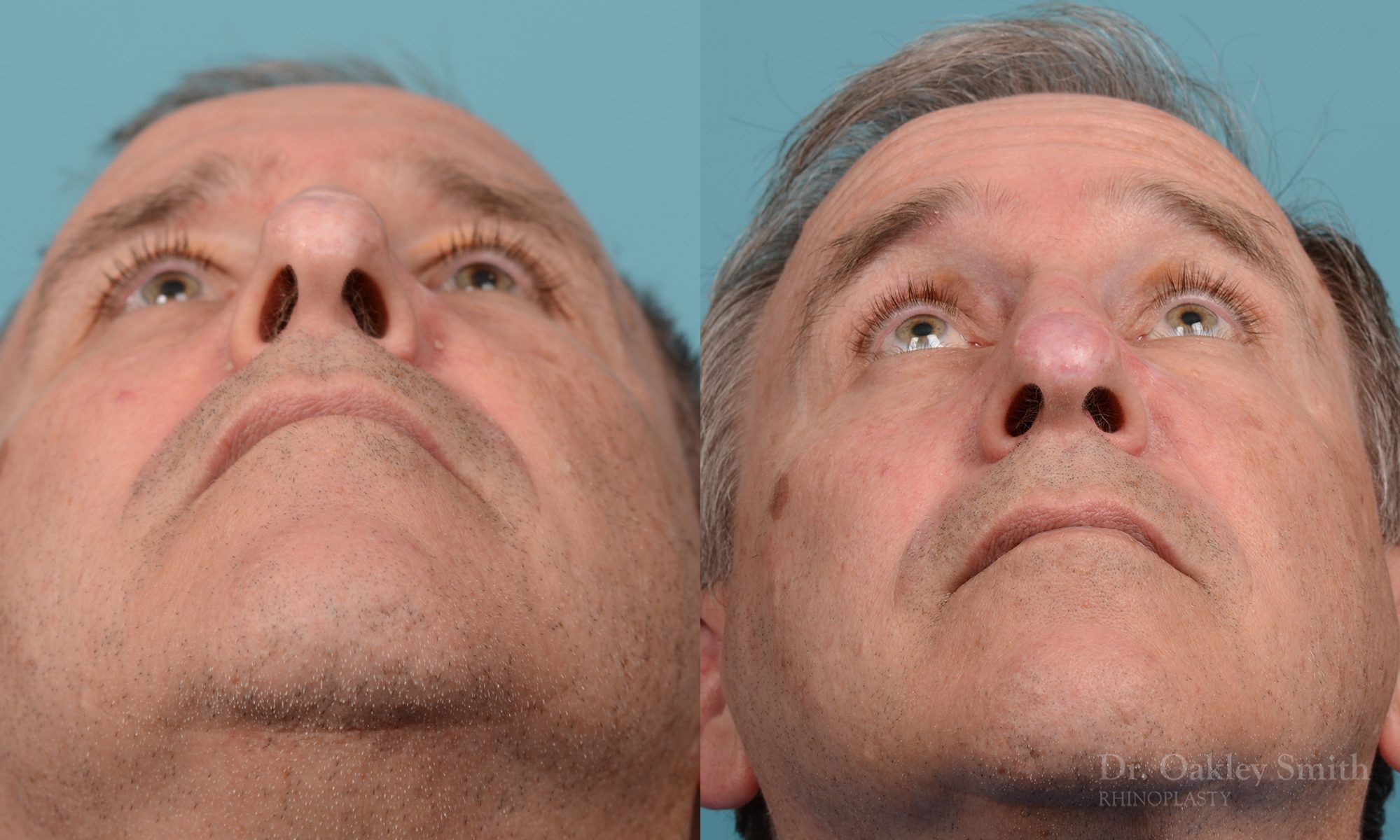 scar removal from previous surgery