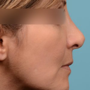 Septoplasty Rhinoplasty to fix breathing and a curved nose