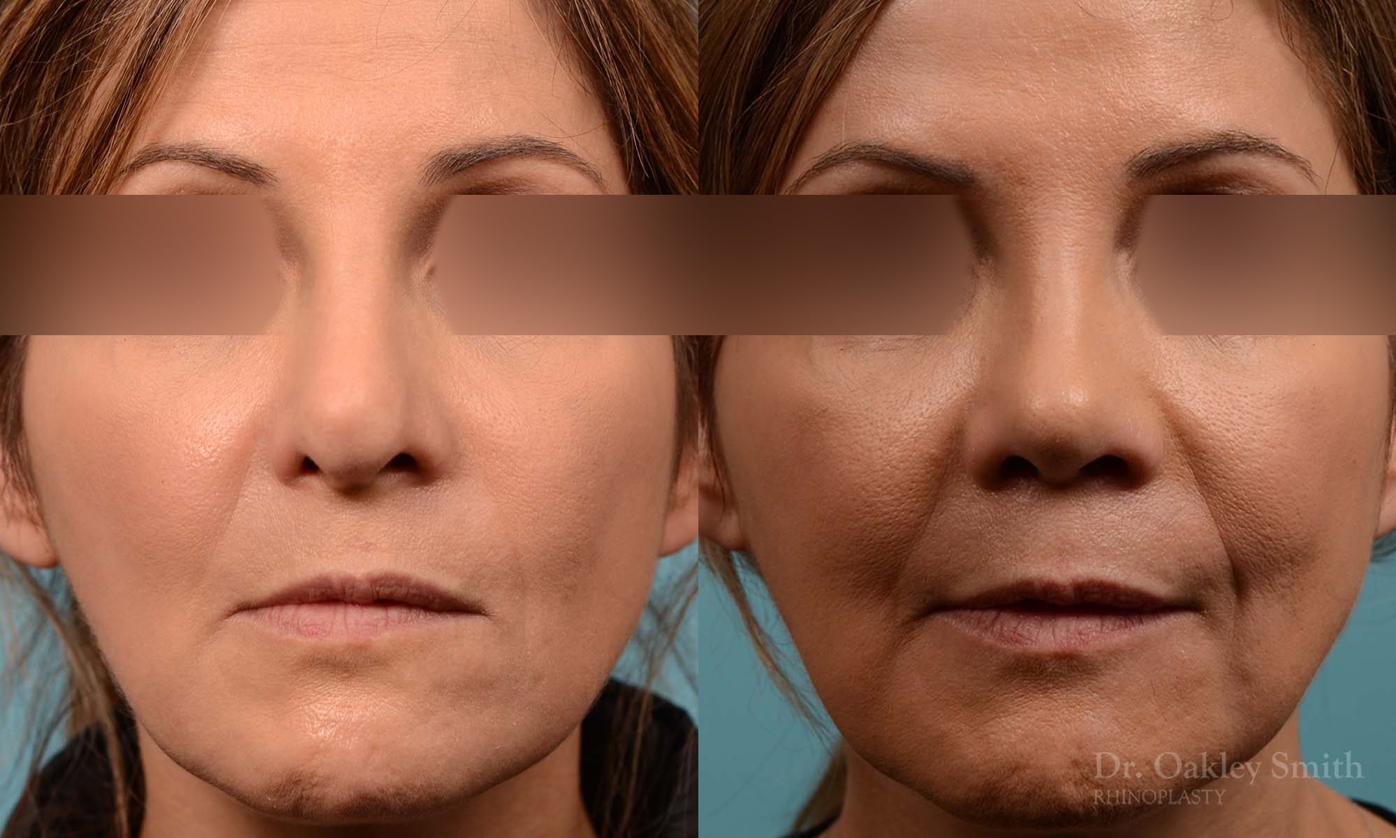 rhinoplasty Nothing demonstrates the skillful craftsmanship that Dr. Oakley Smith accomplishes during his surgeries than a collection of before and after case studies. As one of a hand full of surgeons in North America who limits his practice to only Rhinoplasty surgery, it is obvious that he has mastered his art. There is no question why he is one of the busiest cosmetic nose job surgeons in the country.