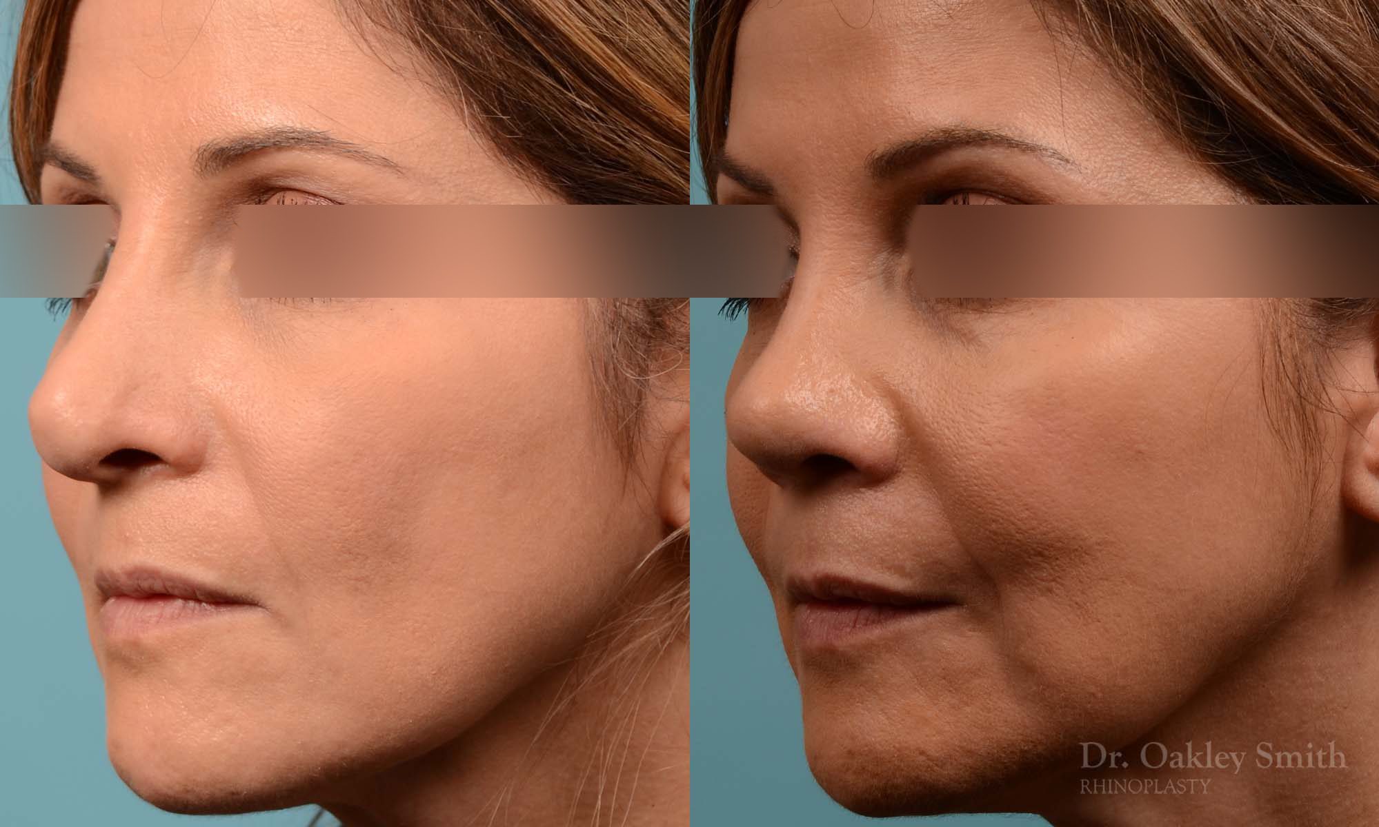rhinoplasty Nothing demonstrates the skillful craftsmanship that Dr. Oakley Smith accomplishes during his surgeries than a collection of before and after case studies. As one of a hand full of surgeons in North America who limits his practice to only Rhinoplasty surgery, it is obvious that he has mastered his art. There is no question why he is one of the busiest cosmetic nose job surgeons in the country.