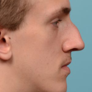 Male rhinoplasty for a curved nose