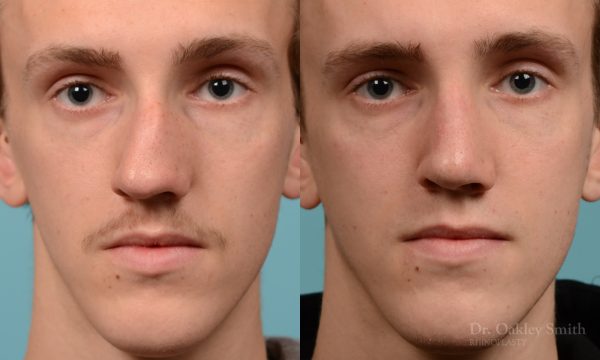 Male rhinoplasty for a curved nose