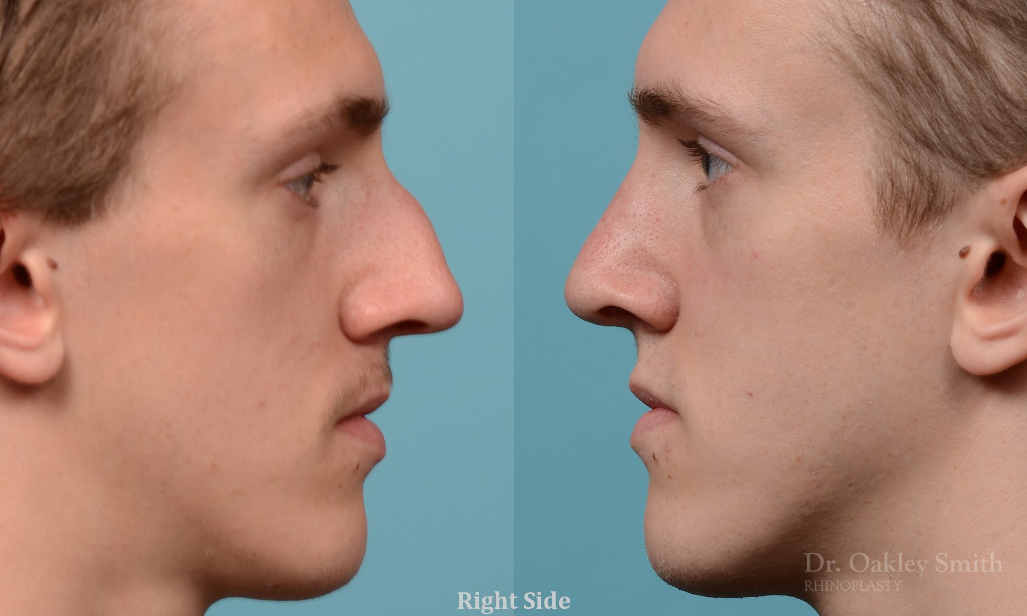 Male rhinoplasty for a curved nose