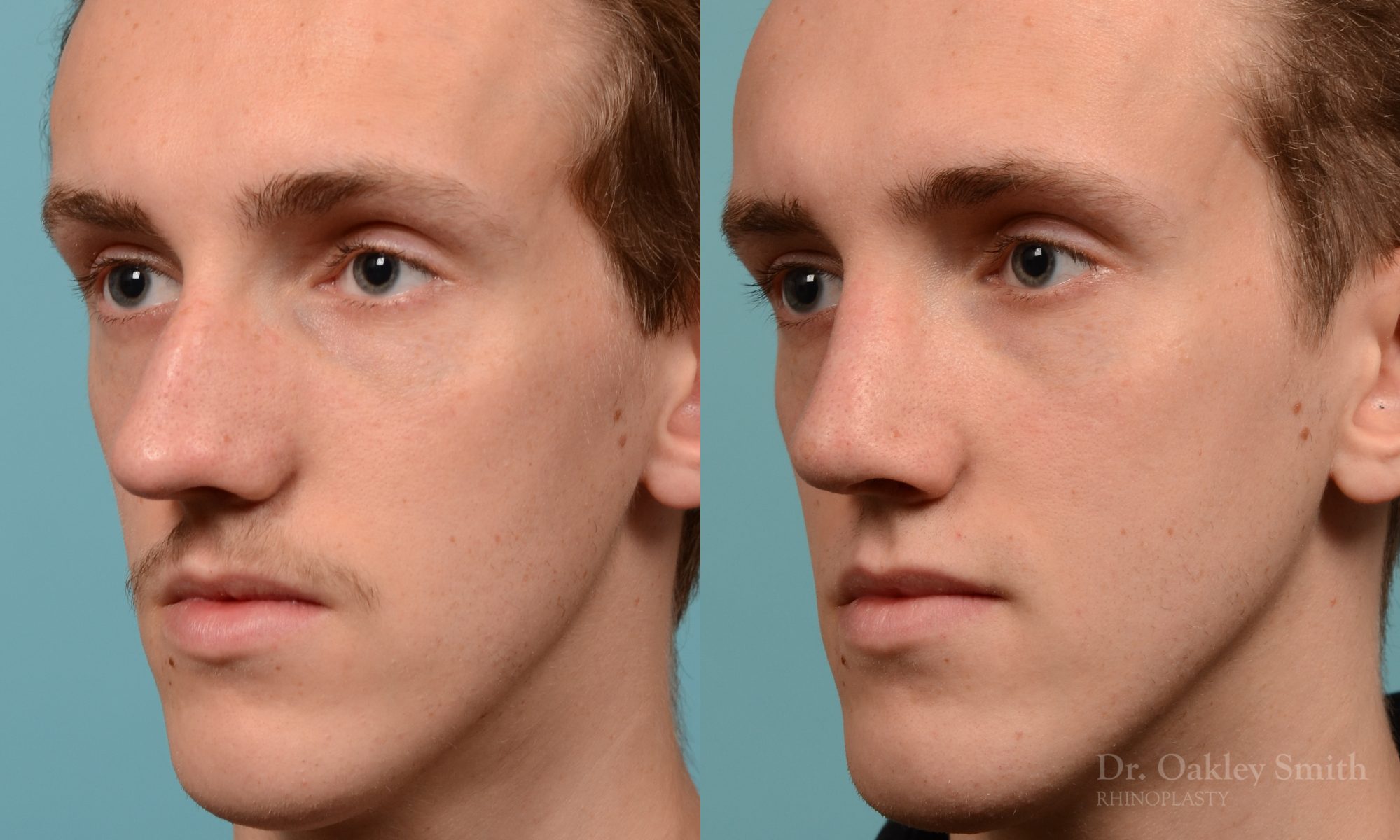 Male rhinoplasty for a curved nose