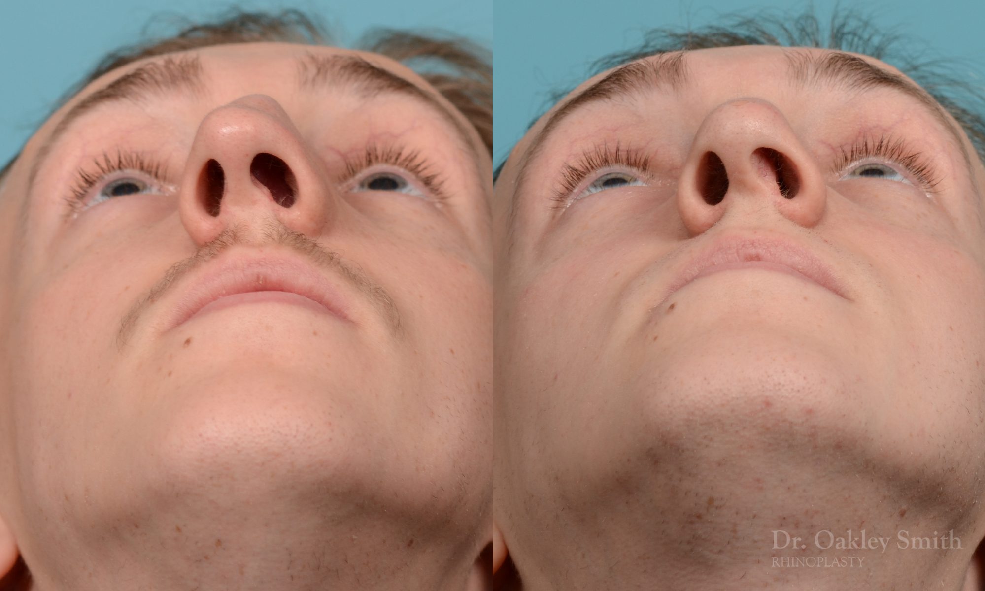 Male rhinoplasty for a curved nose