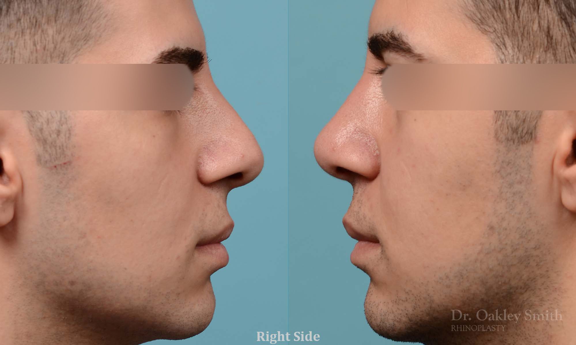 male rhinoplasty deviated septum