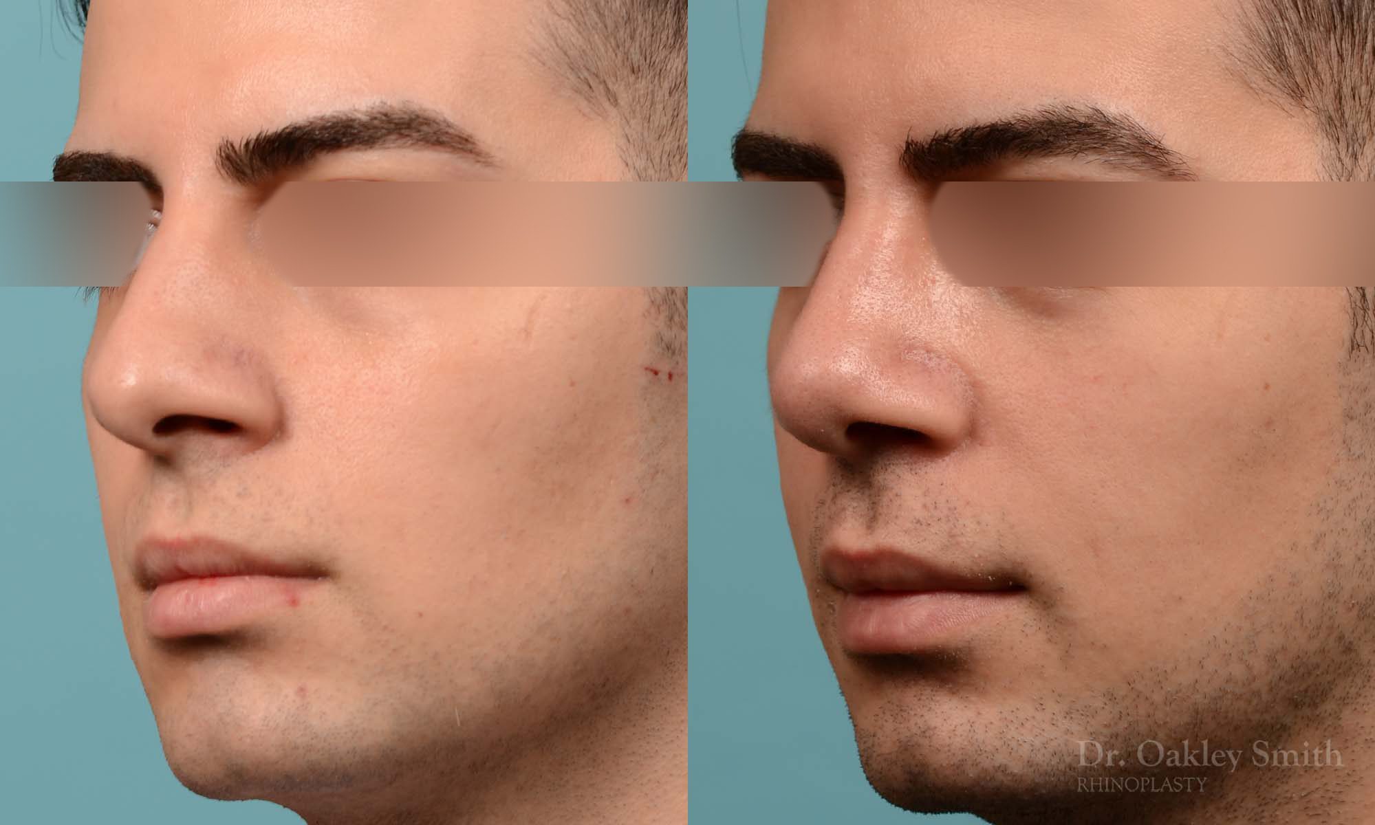 male rhinoplasty deviated septum