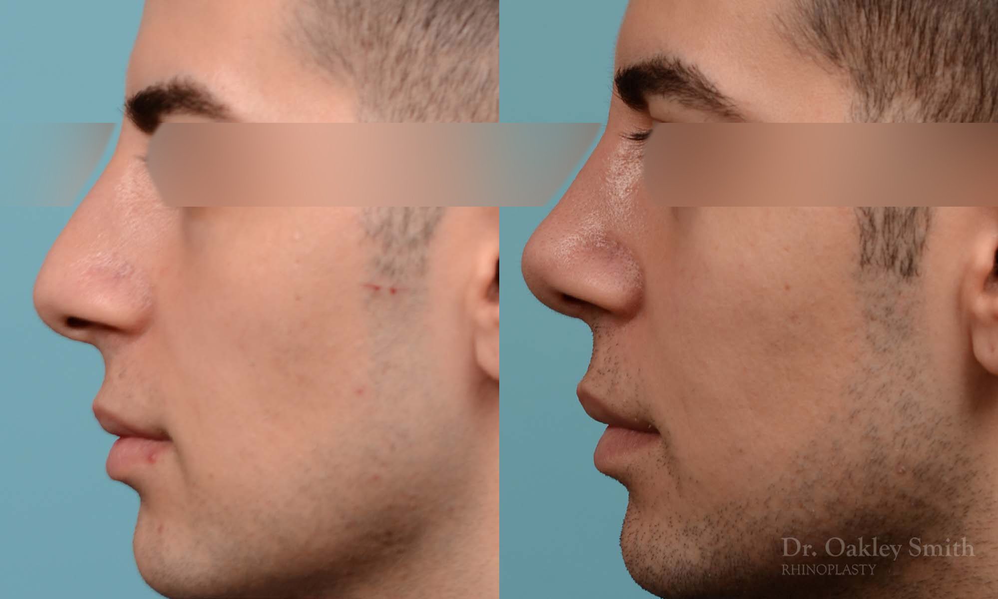 male rhinoplasty deviated septum