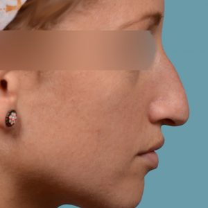 rhinoplasty hump reduction