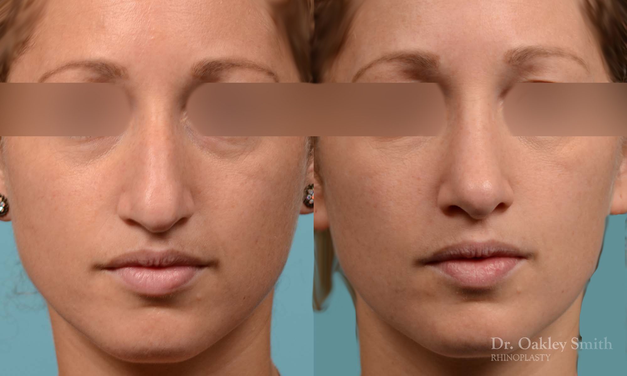 rhinoplasty hump reduction