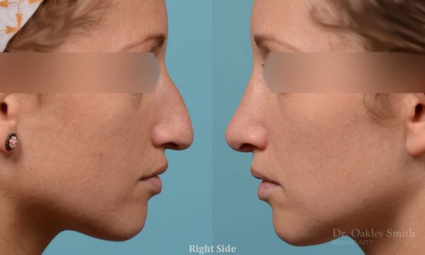 rhinoplasty hump reduction