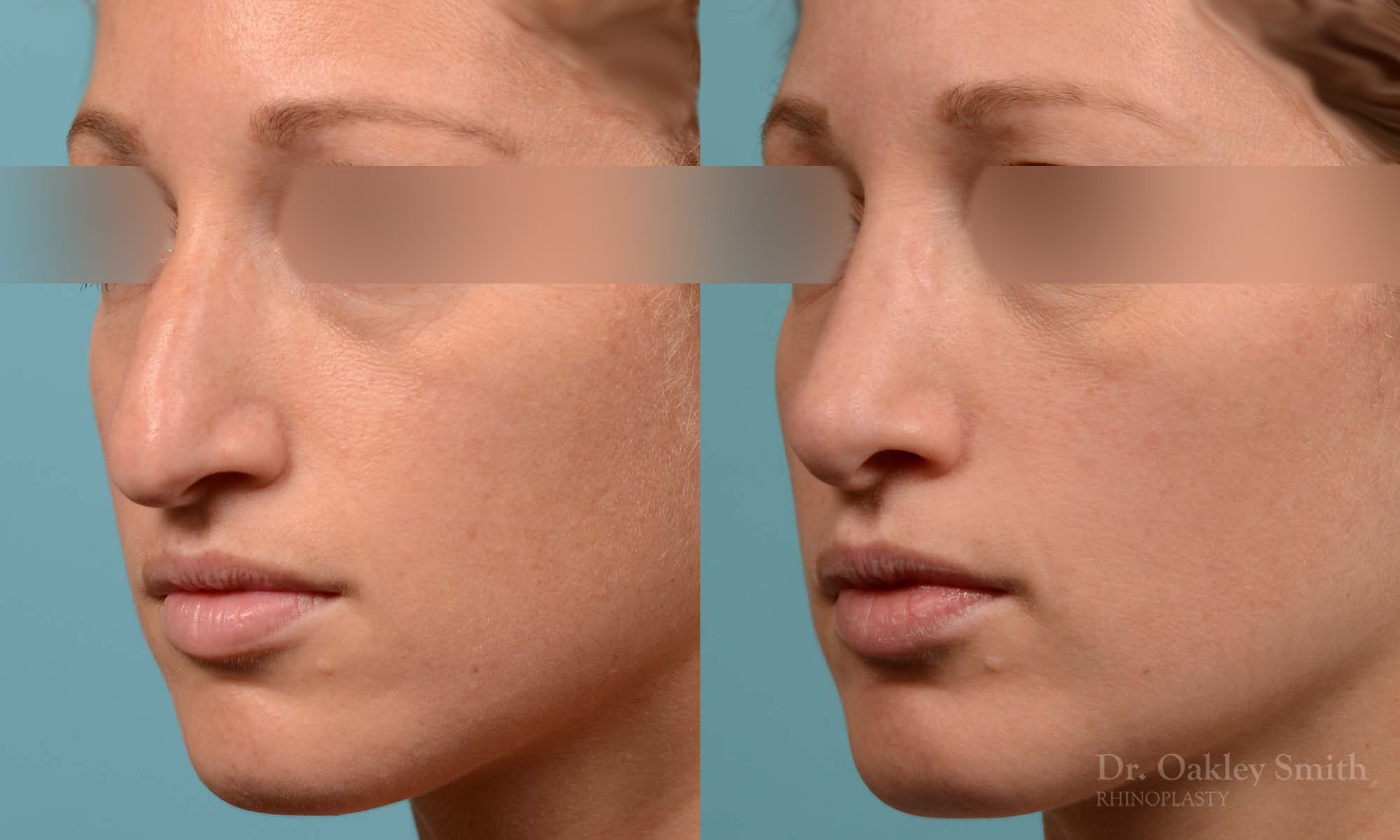 rhinoplasty hump reduction