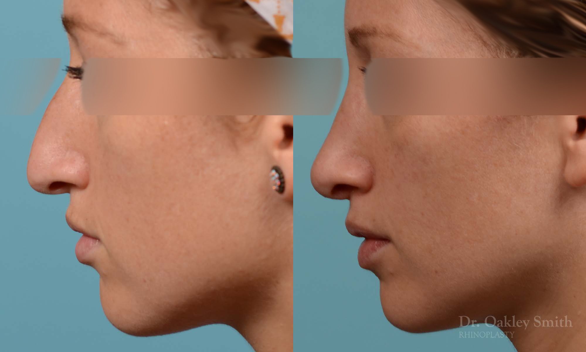 rhinoplasty hump reduction