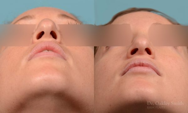 rhinoplasty hump reduction