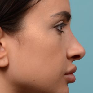 rhinoplasty narrowed bridge