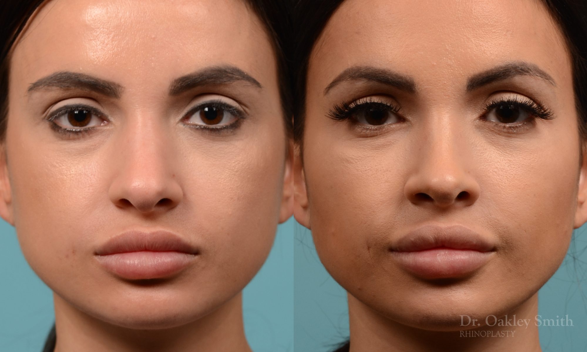 Female nose reduction rhinoplasty