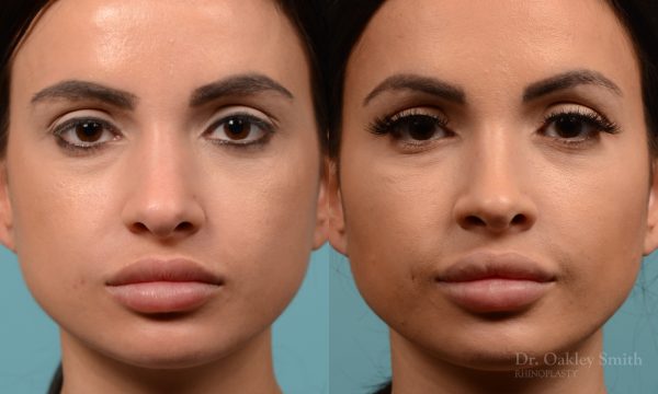 Female nose reduction rhinoplasty