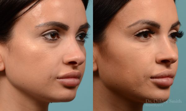 Female nose reduction rhinoplasty