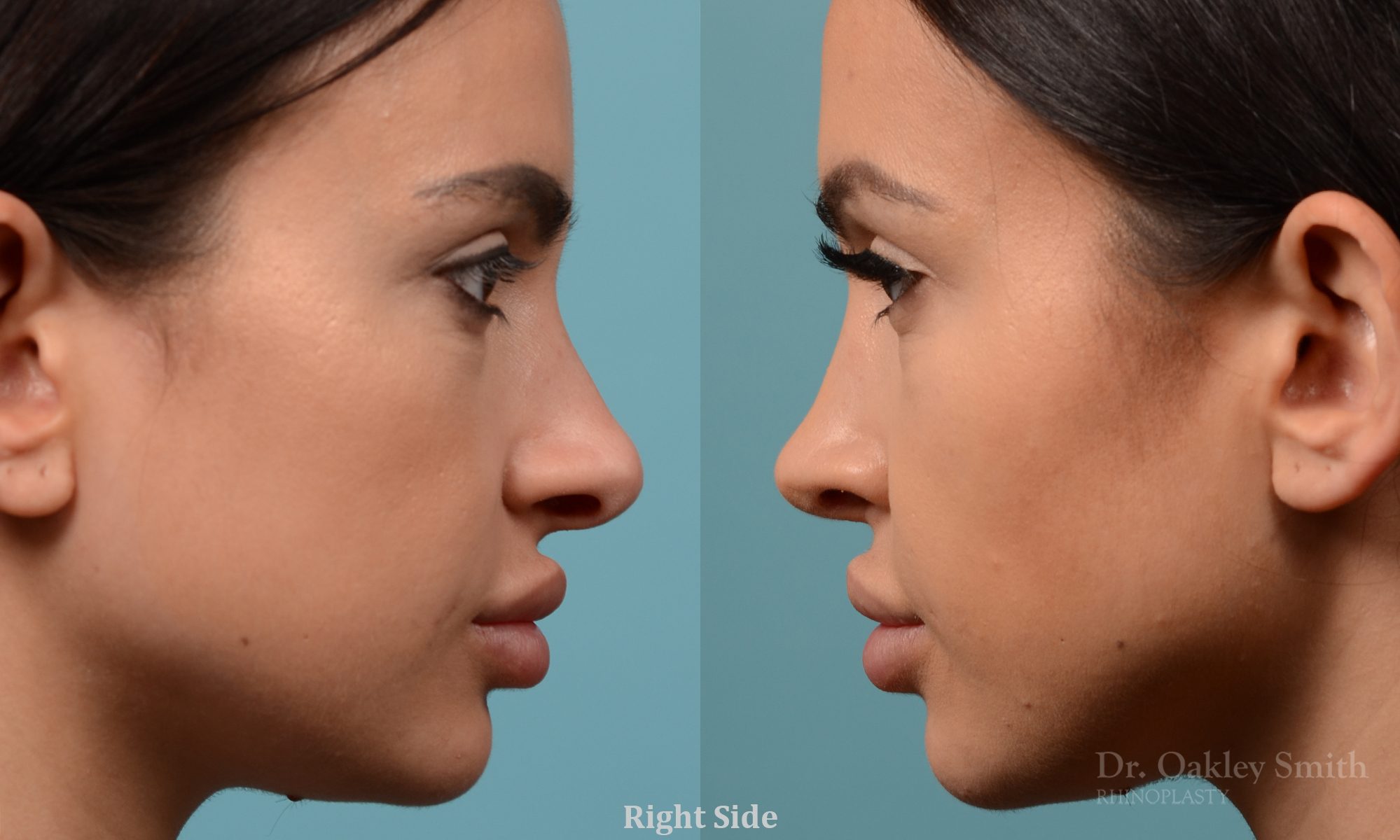 Female nose reduction rhinoplasty