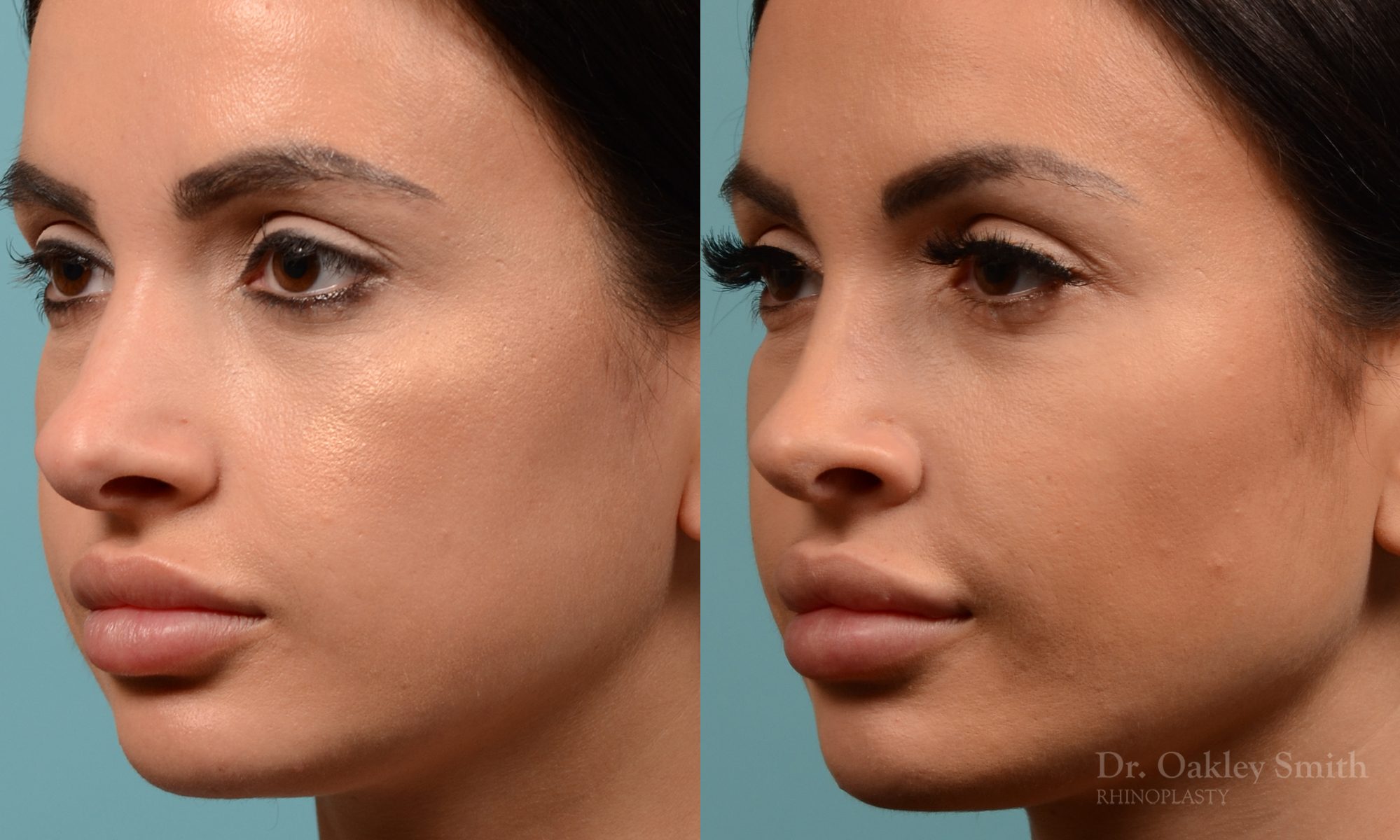 Female nose reduction rhinoplasty