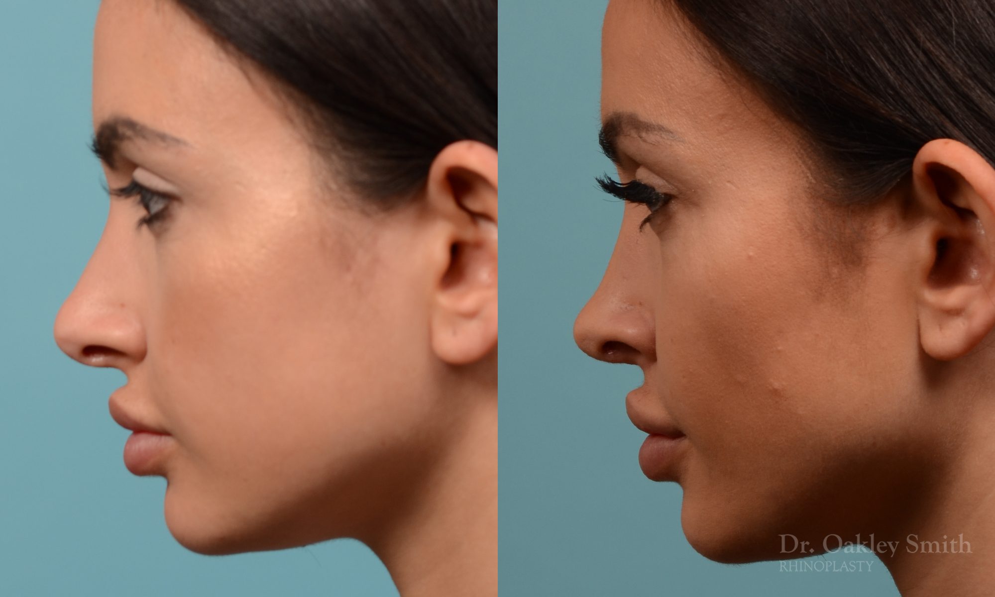 Female nose reduction rhinoplasty