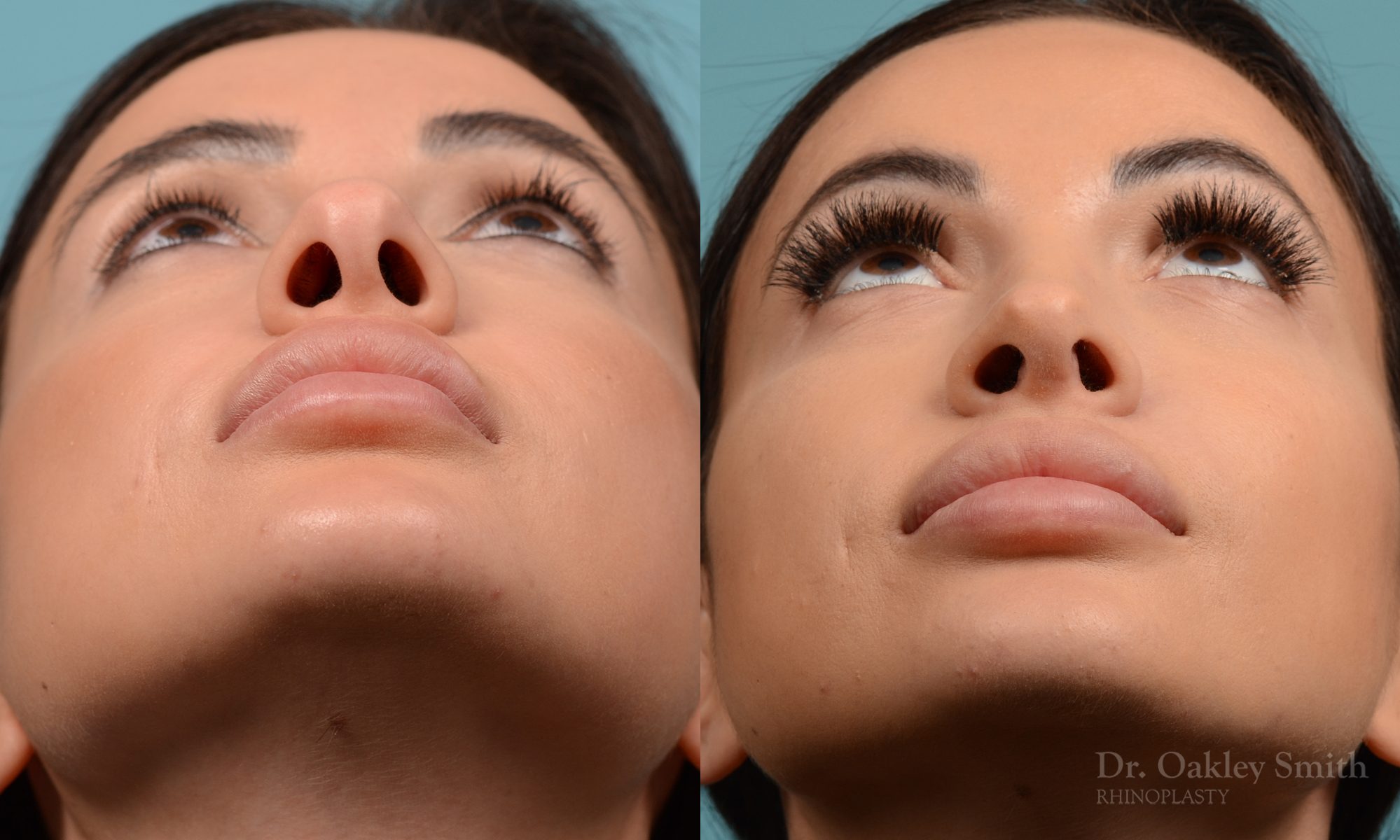 Female nose reduction rhinoplasty
