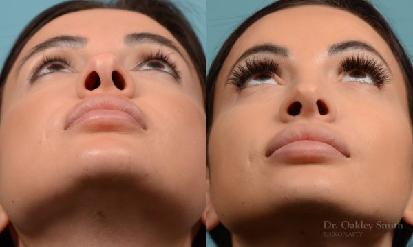 Female nose reduction rhinoplasty