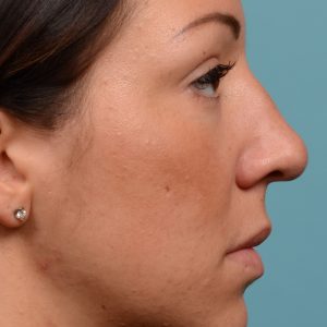 Rhinoplasty hump removal