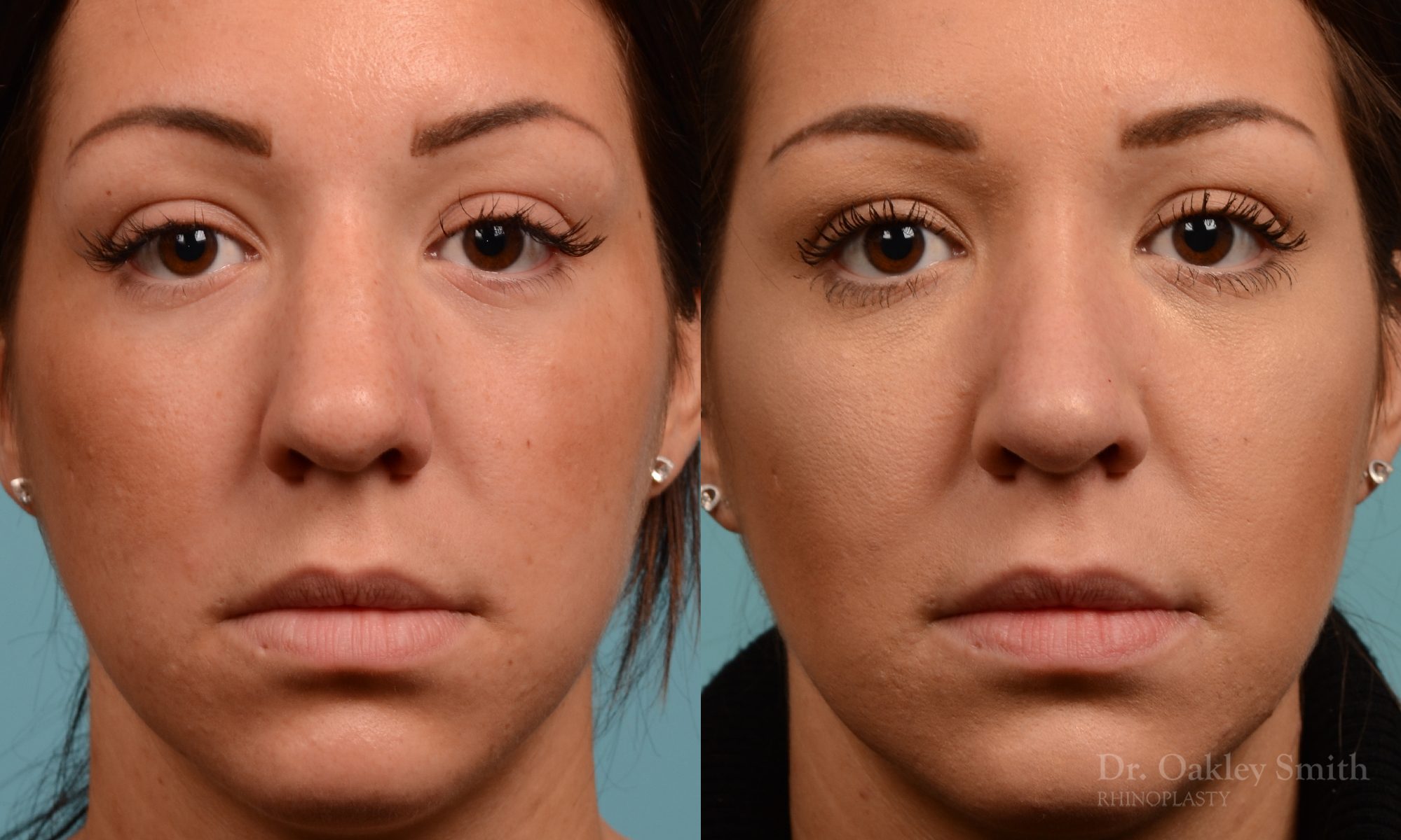 Rhinoplasty hump removal
