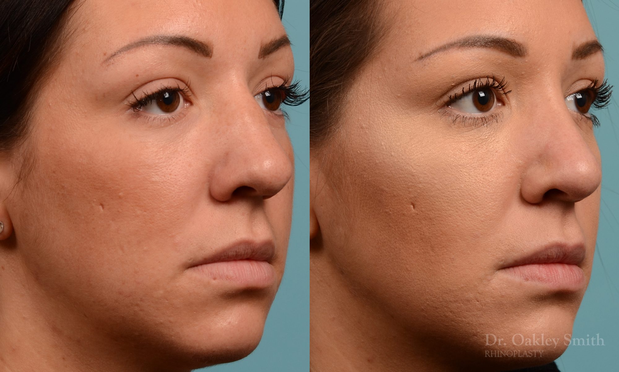 Rhinoplasty hump removal