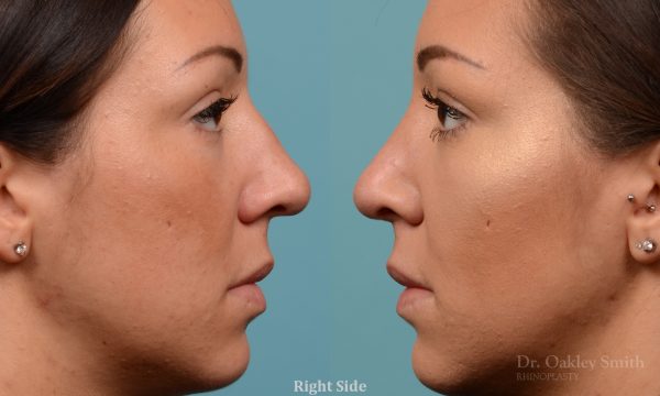 Rhinoplasty hump removal