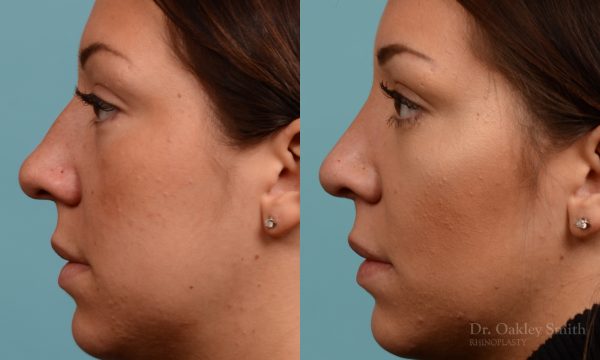 Rhinoplasty hump removal