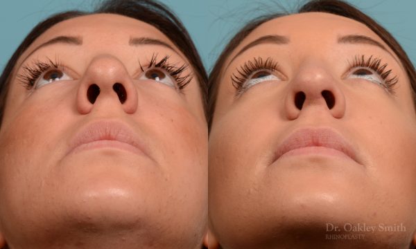 Rhinoplasty hump removal