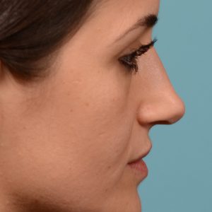 Rhinoplasty curved nose