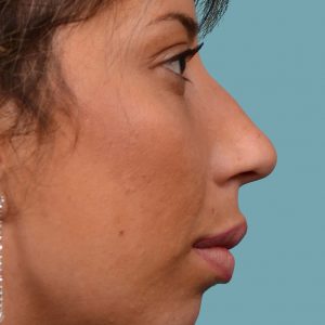 Rhinoplasty hump reduction