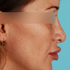 Rhinoplasty curved nose