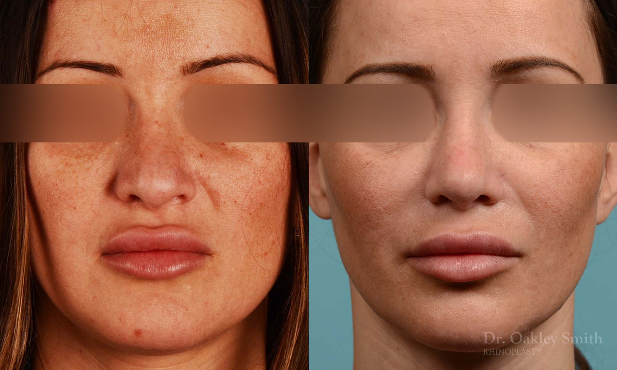 Rhinoplasty curved nose