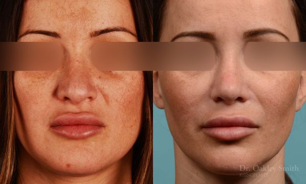 Rhinoplasty curved nose