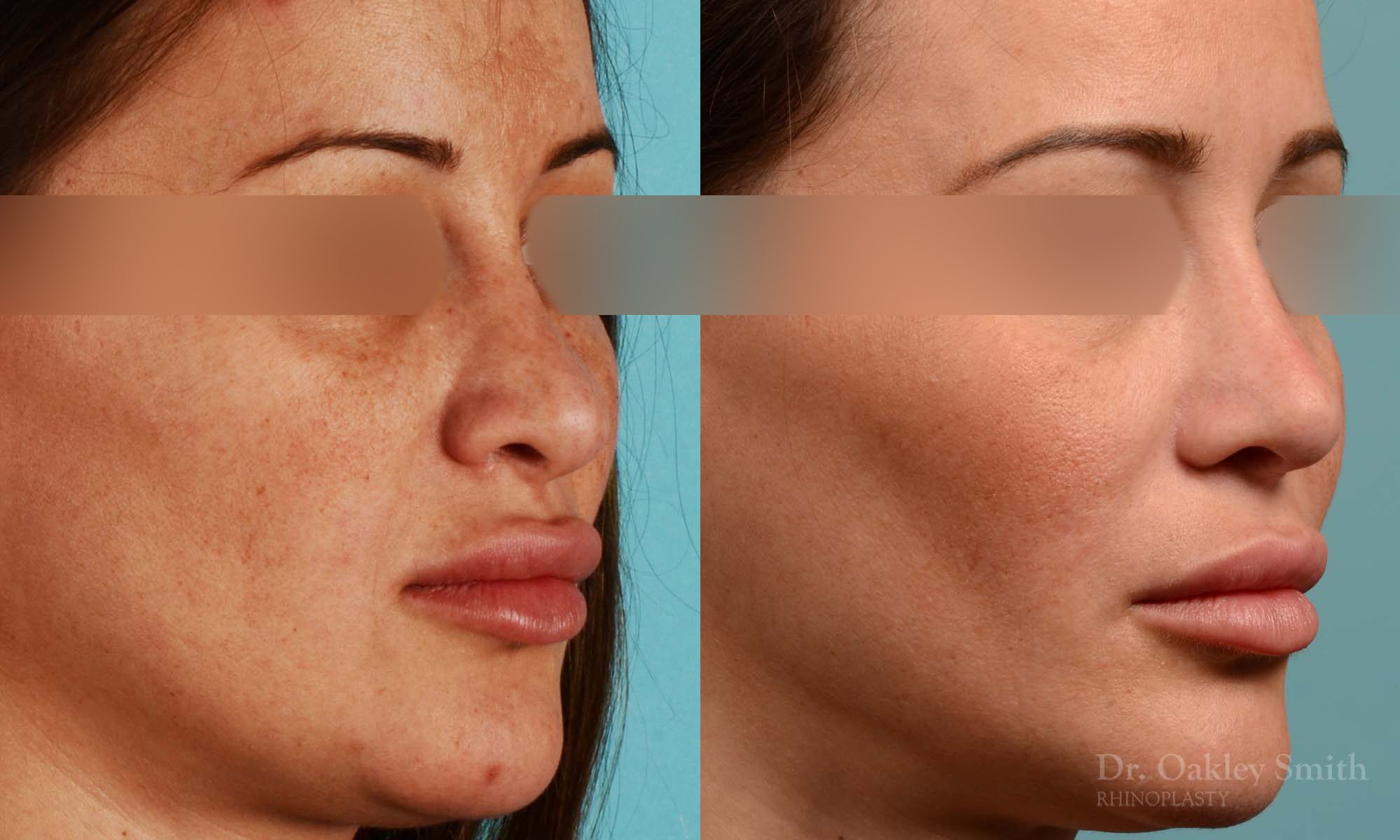 Rhinoplasty curved nose