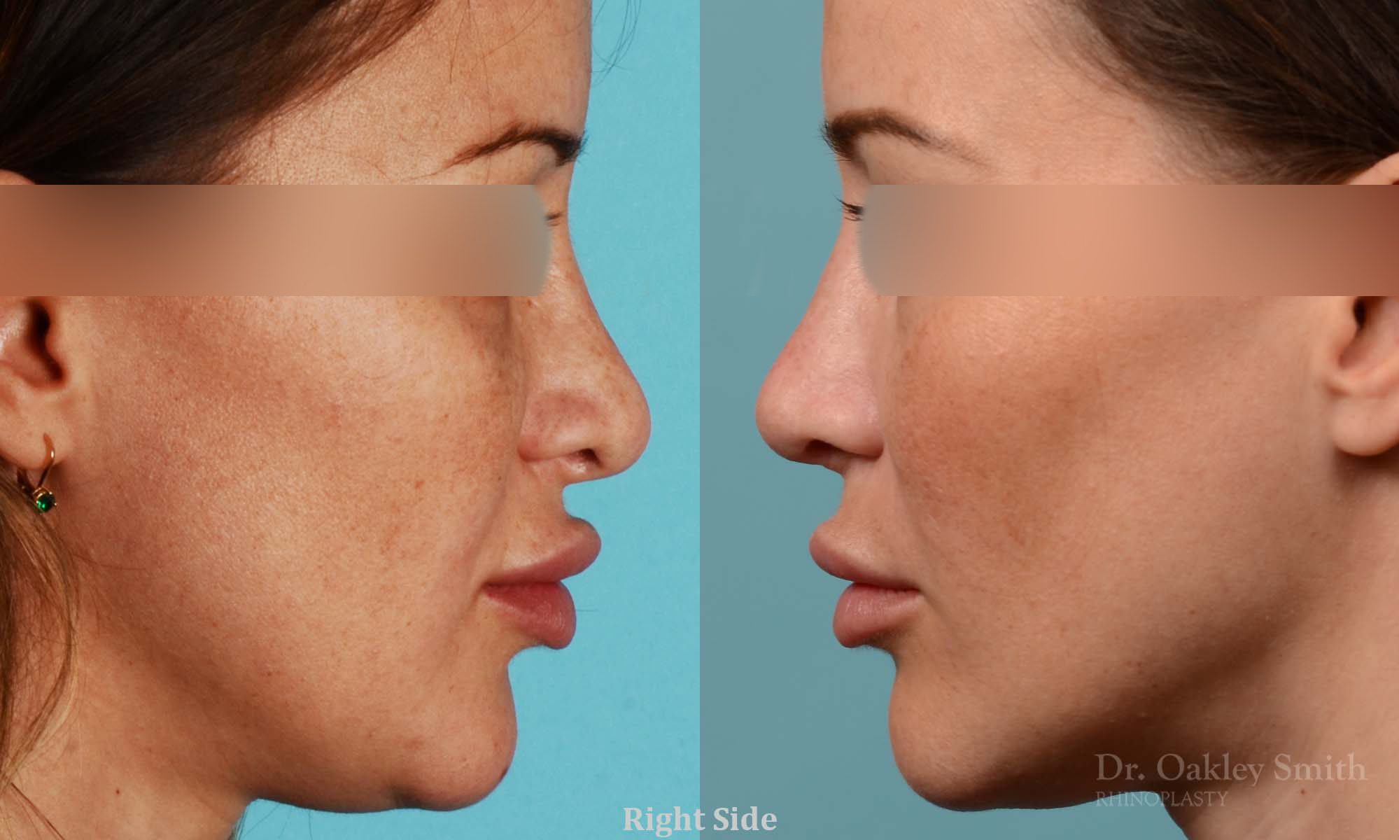 Rhinoplasty curved nose