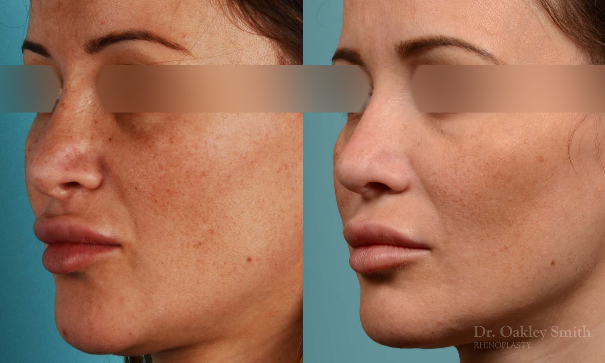 Rhinoplasty curved nose