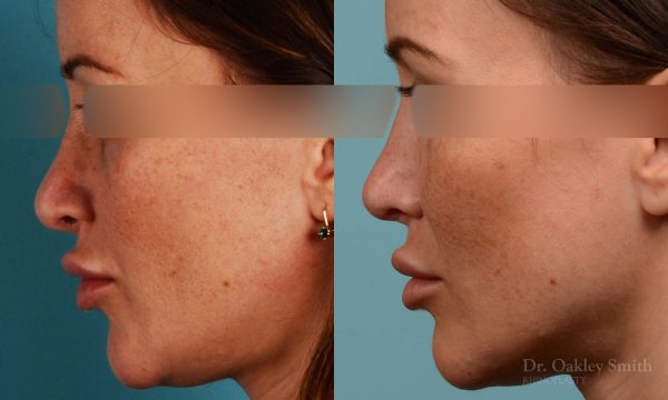 Rhinoplasty curved nose