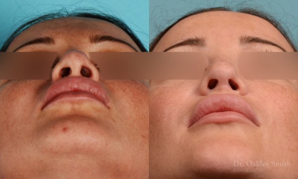 Rhinoplasty curved nose