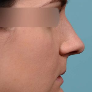 Rhinoplasty hump removal