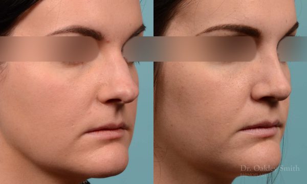 Rhinoplasty hump removal