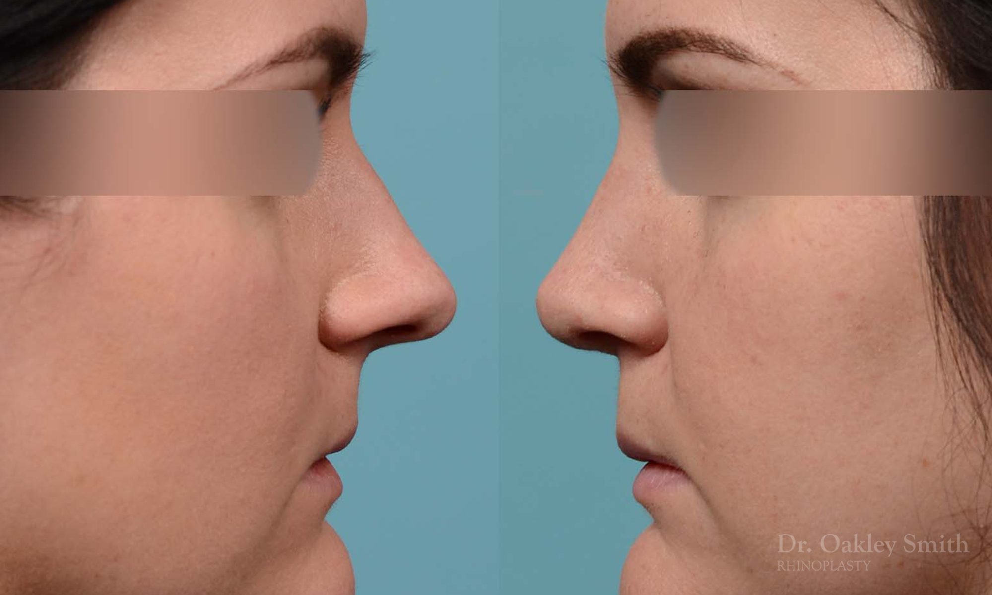Rhinoplasty hump removal